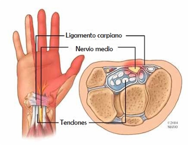 Síndrome de Túnel carpiano: Enfermedad común y dolorosa - Instituto  Traumatologico